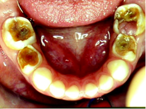 Apa itu perawatan saluran akar (root canal treatment)? apa saja tanda-tanda gigi yang perlu perawatan saluran akar?