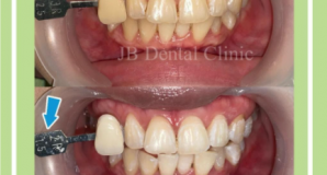Hasil Teeth Whitening JB-Dental