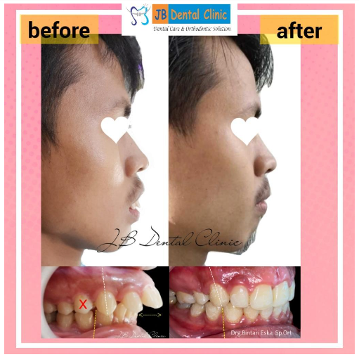 Perawatan Ortodonti: Kasus Gigi Depan Maju, Sehingga Bibir Tidak Dapat Menutup Sempurna