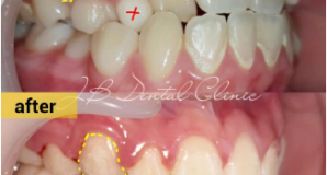 Perawatan Ortodonti: Kasus Gigi Transposisi