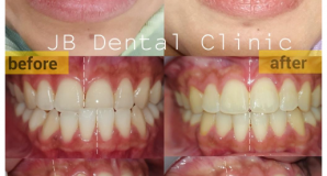 Perawatan Ortodonti: Kasus Gigi Bawah Maju & Dagu Agak Miring
