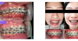 Perawatan Kasus Scissor Bite (retreatment case)