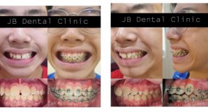 KASUS IMPAKSI GIGI TARING ATAS (GIGI TARING MASIH TERTANAM DALAM TULANG)