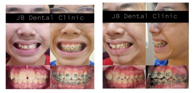 KASUS IMPAKSI GIGI TARING ATAS (GIGI TARING MASIH TERTANAM DALAM TULANG)