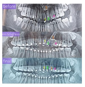 foto-xray-impaksi-gigi-taring-atas-setelah-treatment-jb-dental