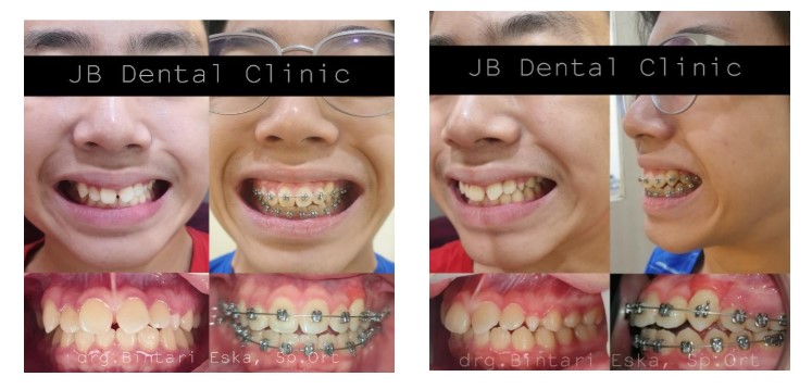 impaksi-gigi-taring-atas