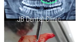 Kasus Pencabutan Gigi Taring Atas Impaksi Dengan Pembedahan